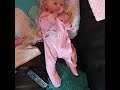 Hopes Seizures 3 Months Old Infantile Spasms Generalised Focal Tonic Epilepsy Brain Damage