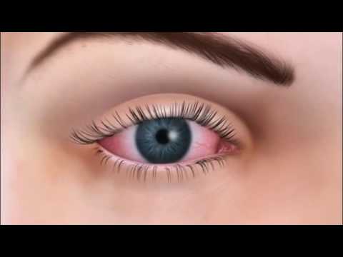 Beverly Hills Optometry - How Patients develop unhealthy Tears? Evaluate Your Oil Glands