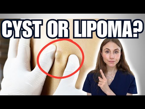 Lumps Under The Skin: Cyst Vs Lipoma