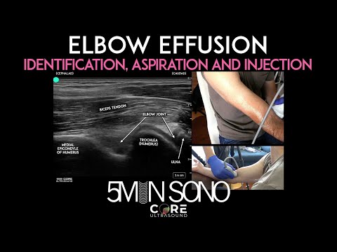 Elbow Effusion - Identification, Aspiration and Injection