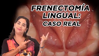 Frenectomía lingual: caso real