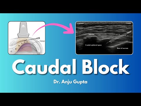 Ultrasound Guided Caudal Block for Paediatric Patients | Dr. Anju Gupta