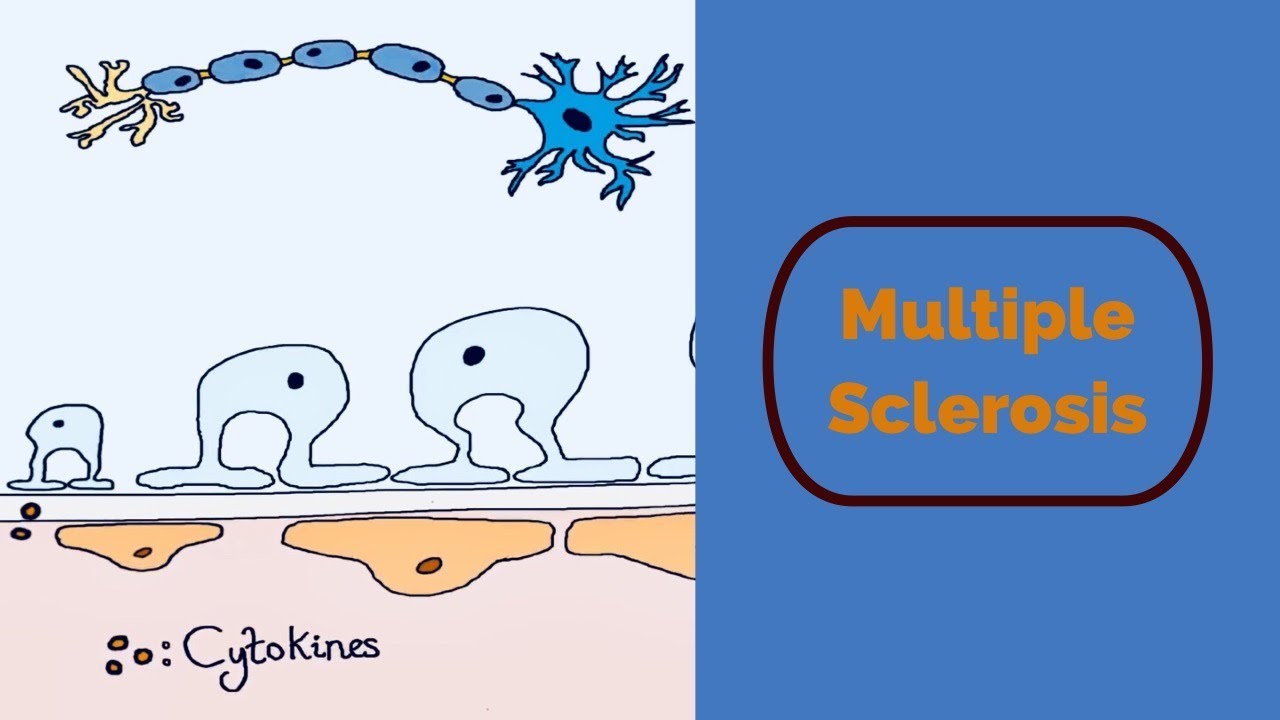 Multiple Sclerosis
