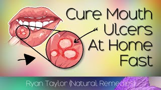 Cure Mouth Ulcers Permanently (Canker Sores)