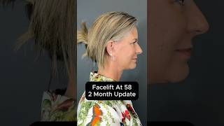 'Facelift At 58 - 2 Month Update