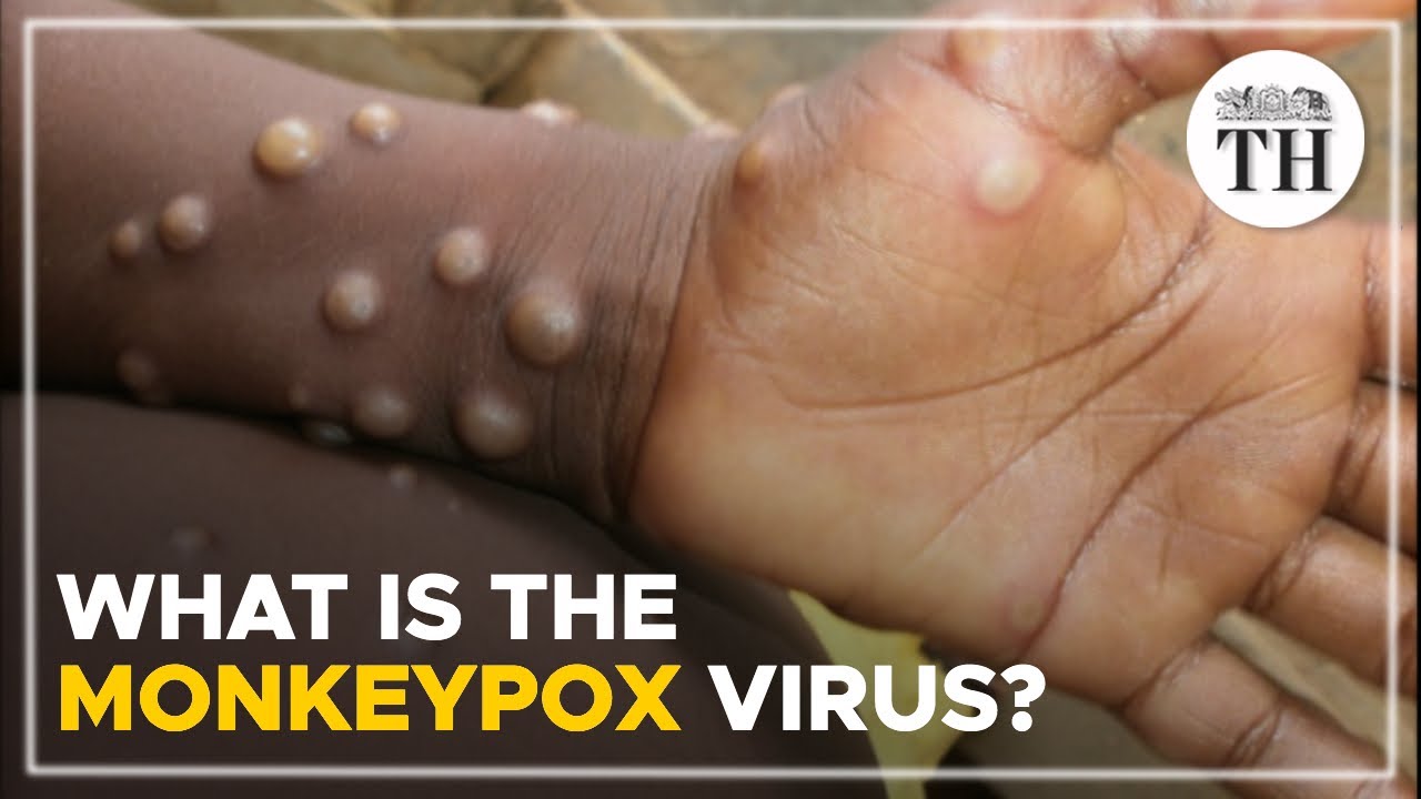 What is the monkeypox virus? | The Hindu