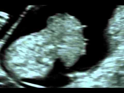 Fetal Medicine Foundation - Pentalogy of Cantrell