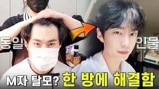 M자탈모로 고민하는 20대 필수시청!! 10초만에 풍성해지는필살기