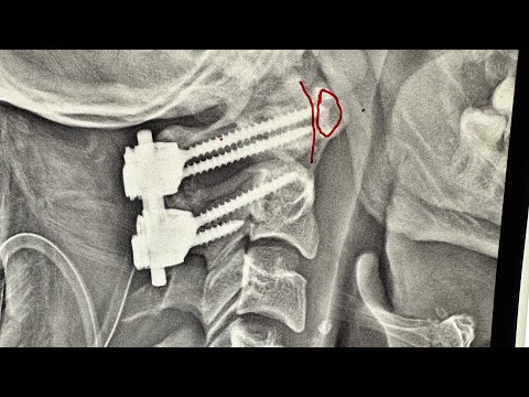 Spinal Spondylolisthesis Explained | Dr. Ajay Kothari