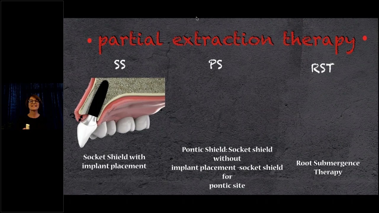 BEGO Implant Systems – Partial Extraction Therapy Socket Shield