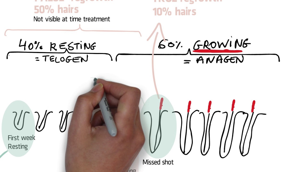 Hair removal - Electrolysis for permanent hair removal - o2 Clinic Hair removal - Electrolysis for permanent hair removal - o2 Clinic