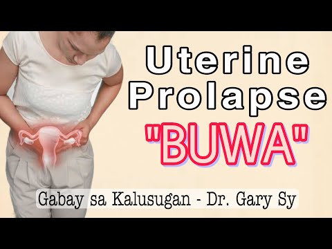Uterine Prolapse (BUWA) - Dr. Gary Sy