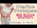 Uterine Prolapse (BUWA) - Dr. Gary Sy