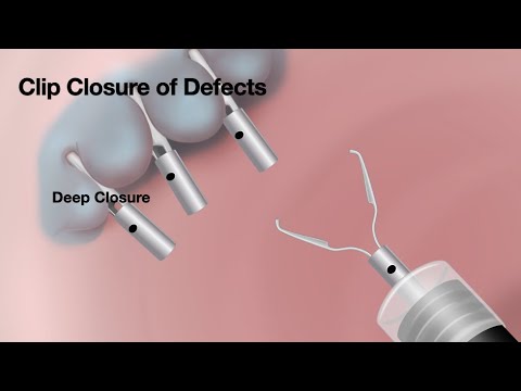 HCC 1475-28A - Through the scope clips
