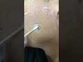 All Natural Skin Tag Remover Serum Order Link In Description