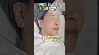 리쥬란으로 속건조 잡은 후기💯