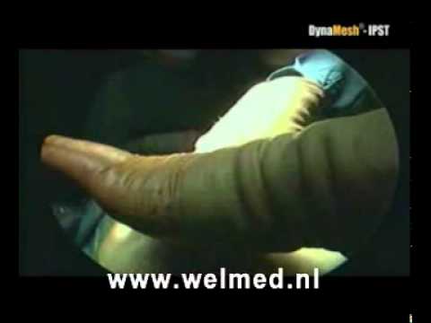 DynaMesh IPST Welmed