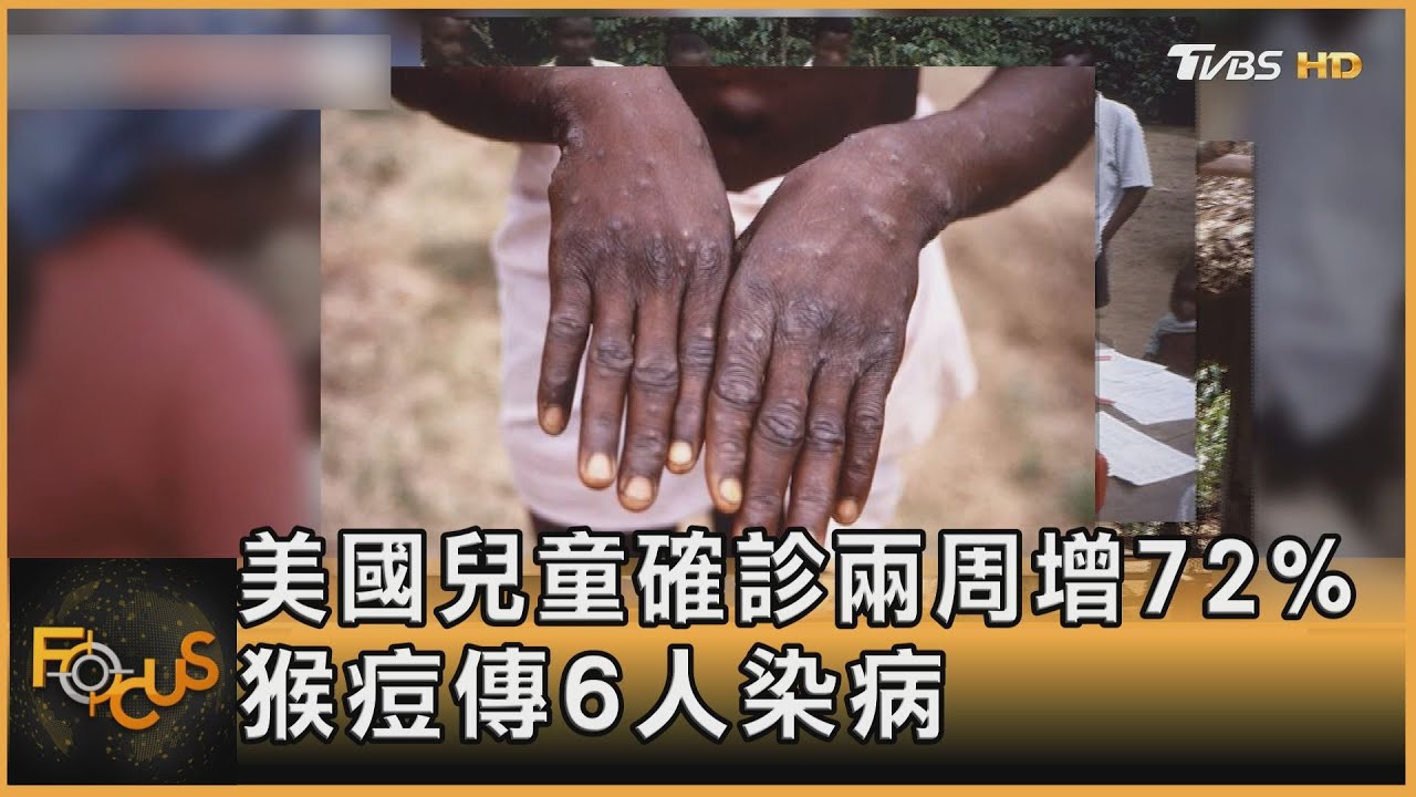 美國兒童確診兩周增72% 猴痘傳6人染病
