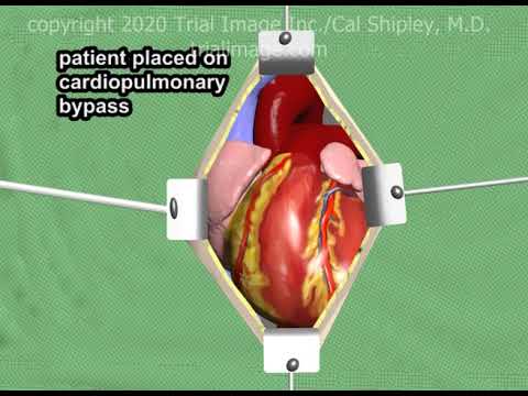 How Long Does a Left Ventricular Assist Device (LVAD) Battery Last