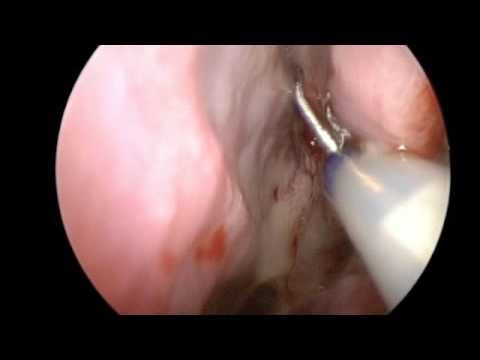 Balloon Sinuplasty of Sphenoid Sinus