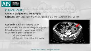 Laparoscopic Sigmoidectomy in a Locally Advanced Colon Tumor