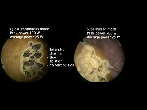 Thulium fiber laser. Lithotripsy and tissue cutting in QCW and SuperPulse modes