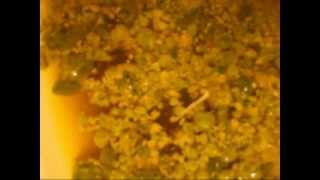 Liver & Gallbladder Flush Harvest Results - Hundreds Of Liver Stones & Gallstones