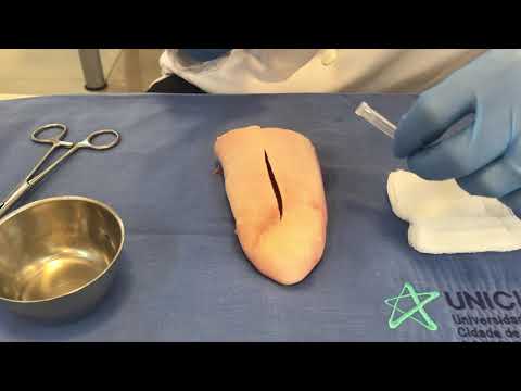 Infiltration of local anesthetic