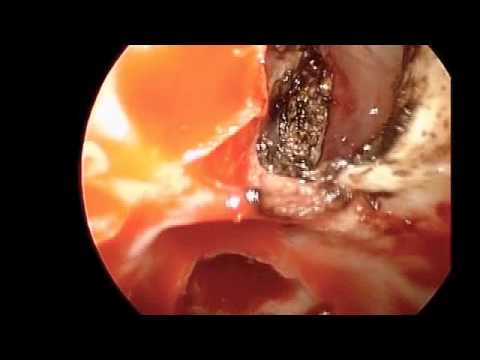 Leak of Cerebrospinal Fluid through Left Supraorbital Ethmoid Sinus and Repair of Defect