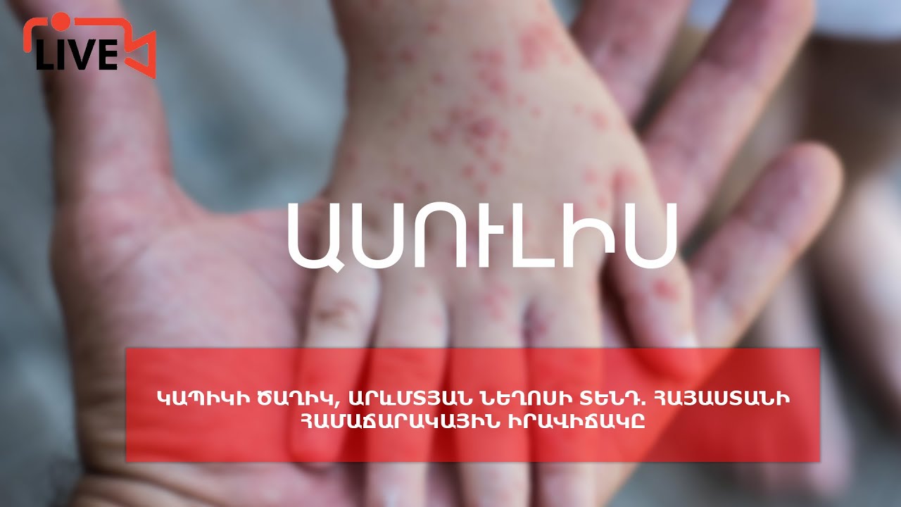 #Ուղիղ. Կապիկի ծաղիկ, Արևմտյան Նեղոսի տենդ. Հայաստանի համաճարակային իրավիճակը