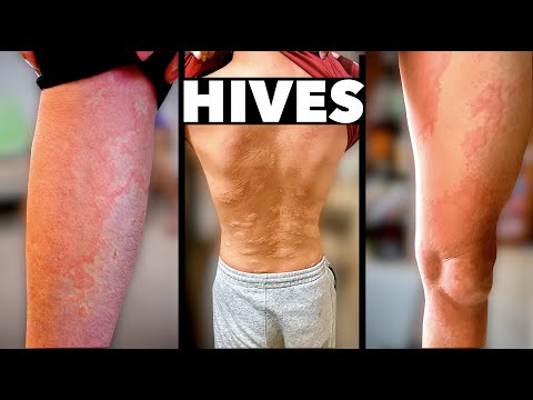 HIVES EVERYWHERE! (What Caused This Allergic Reaction?) | Dr. Paul