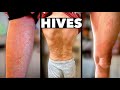 HIVES EVERYWHERE! (What Caused This Allergic Reaction?) | Dr. Paul