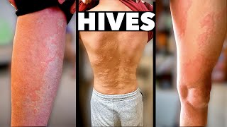 HIVES EVERYWHERE! (What Caused This Allergic Reaction?) | Dr. Paul