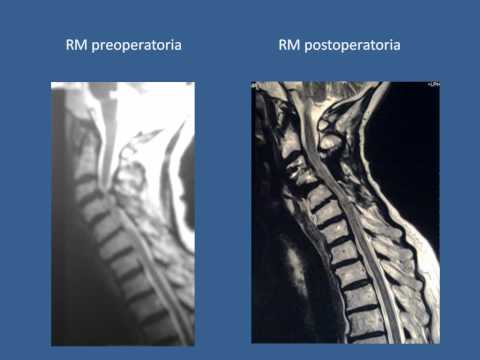Fisioterapia per spalla Malattie infettive del trattamento articolazioni