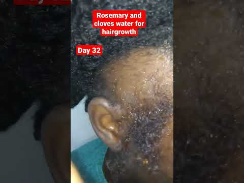 Trying Rosemary and cloves water for hair growth(day 32).