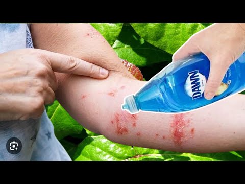 Come sbarazzarsi dell'EDERA VELENOSA con il detersivo per i piatti DAWN (rimedio fai da te veloce)