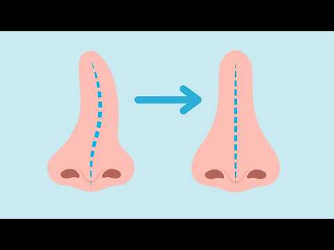 fix deviated septum