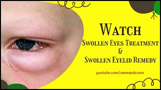 Swollen Eyes Treatment | Puffy Eyelid | How To Treat A Swollen Eye | Swollen Eyelid Remedy