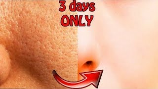 How To Get Rid Of Large OPEN PORES Permanently & Acne Scars Naturally At Home In Just 3 Days