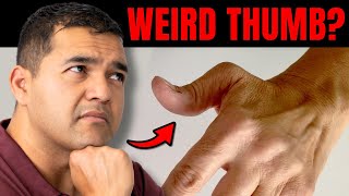 Why Your Thumb Changes Shape With Hand Arthritis