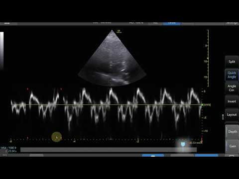 Tissue Doppler Step by Step - Medial e' Example