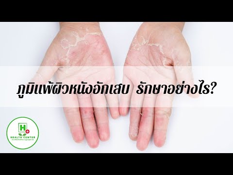 การรักษา SDA หลักสูตรโรคสะเก็ดเงิน สีแดงและลอกของผิวหนังที่มีแผลเปื่อย