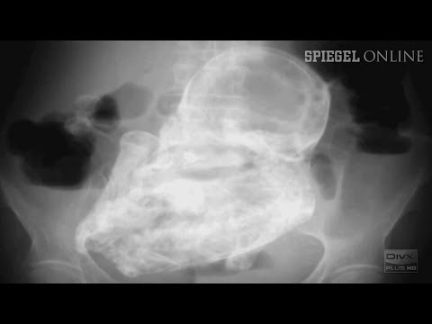 Versteinertes Kind: 40 Jahre alter Fötus im Bauch entdeckt | DER SPIEGEL