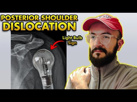 Posterior Shoulder Dislocation: Reduction Technique, Clinical Features, Imaging & Complications