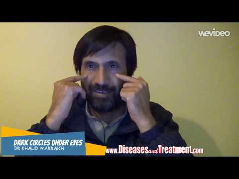 Dark Circles Under Eyes  - What are the causes?