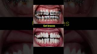 Download lagu Braces evolution #braces #orthodontist #dentist #dental mp3