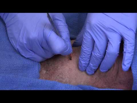 UCSD (surgical)