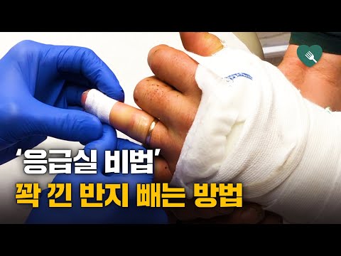 미 유타대학교병원 의사의 반지 빼는 기술 화제