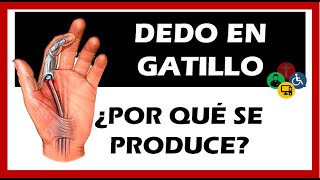 Dedo en gatillo SINTOMAS causas Y TRATAMIENTO
