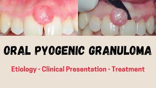 ORAL PYOGENIC GRANULOMA: Etiology - Clinical Presentation - Treatment